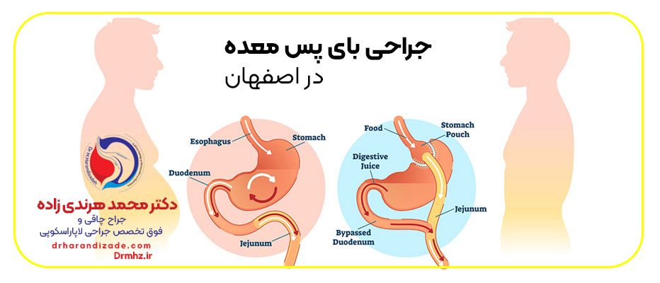Stomach baypass - 4 روش انواع جراحی چاقی در اصفهان