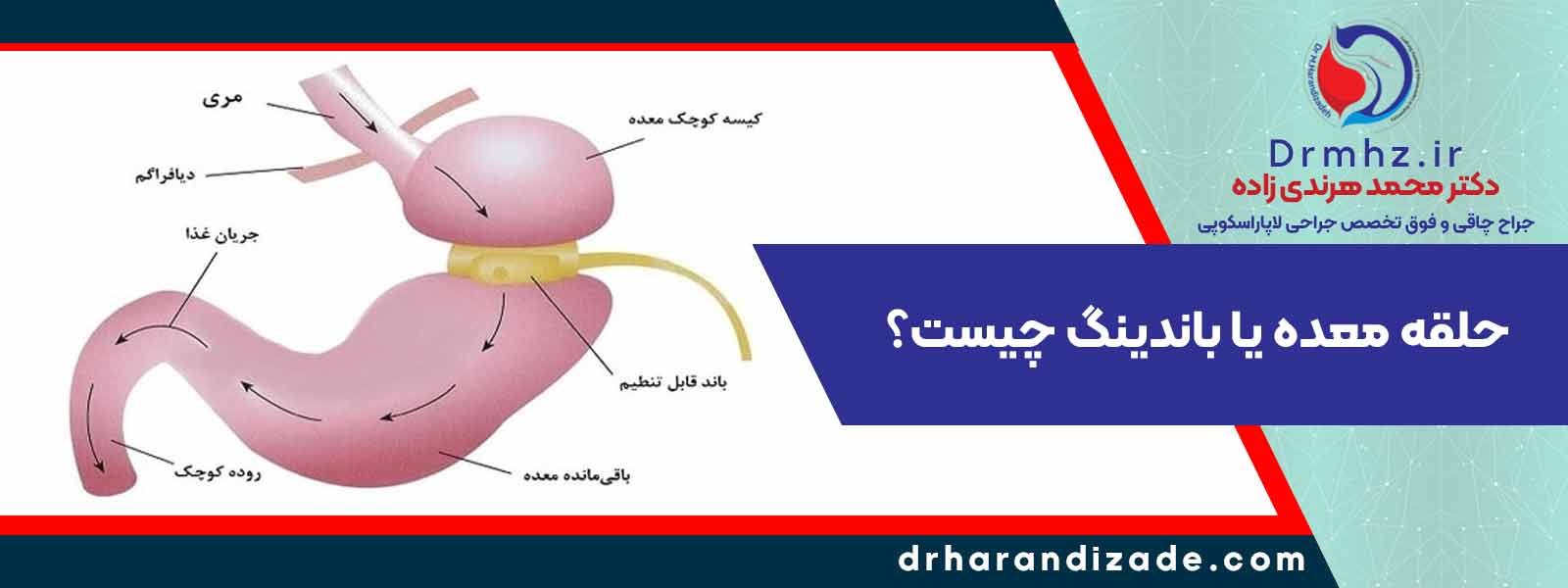 what is a gastric ring - بهترین دکتر برای عمل حلقه معده اصفهان