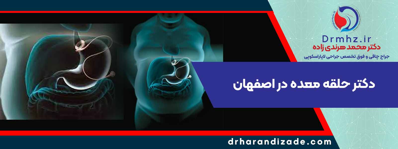 what is a gastricring - بهترین دکتر لاغری در اصفهان