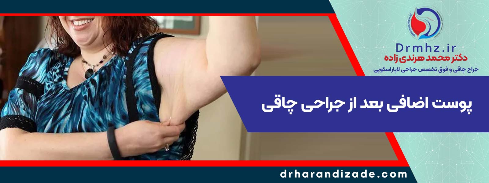 9 excessskin after bariatric surgery - بهترین دکتر لاغری در اصفهان