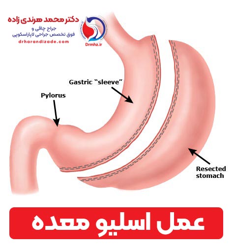 Laparoscopic Sleeve Gastrectomy - اطلاعات عمل sleeve گاسترکتومی در درمان چاقی مفرط